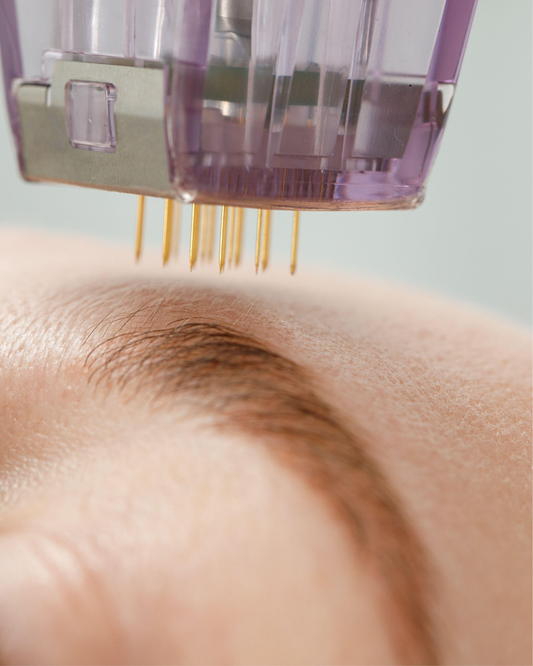 Microneedling