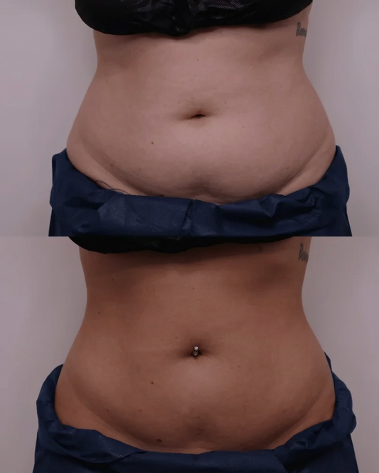 OFFRE Cryolipolyse